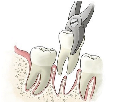 wisdom teeth removal complications coma